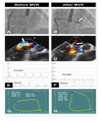 Structural Heart Interventions - MitraClip procedure before and after MVR