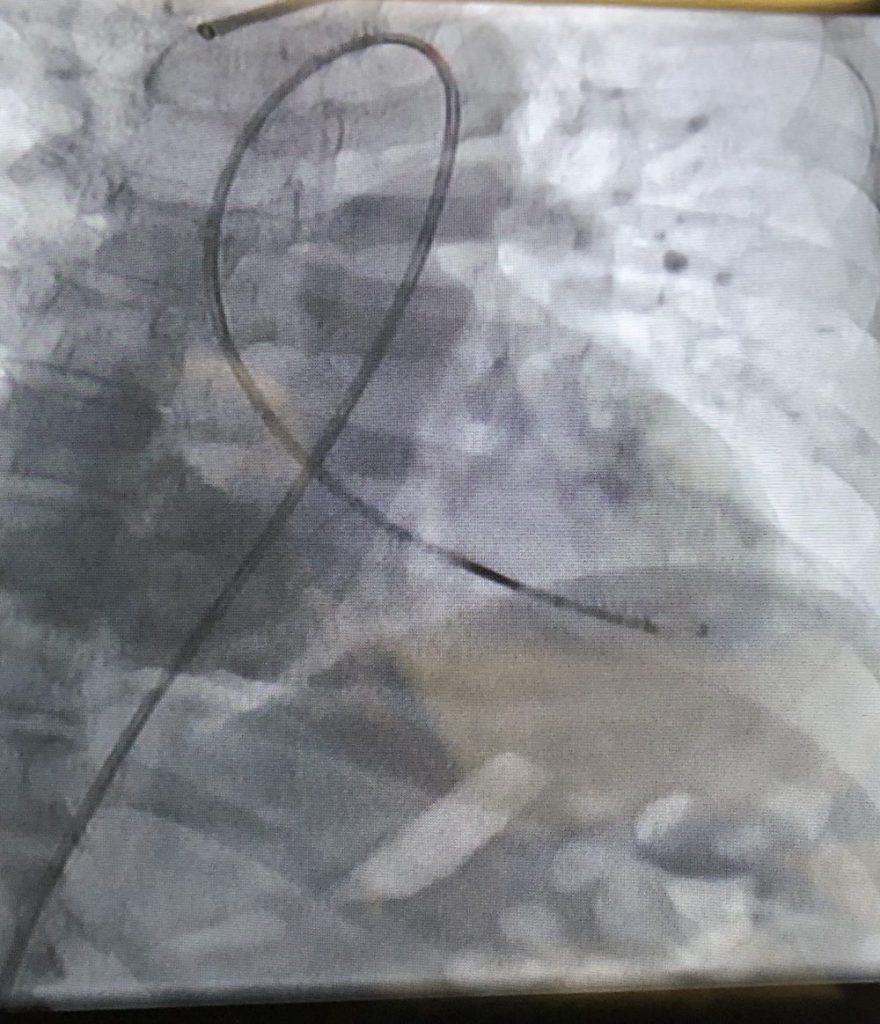 PV Loop Catheter in left ventricle