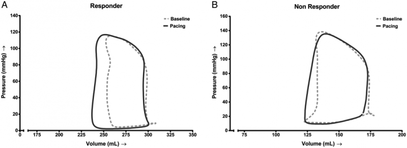 Pressure–volume loops of two different patients during baseline and biventricular pacing